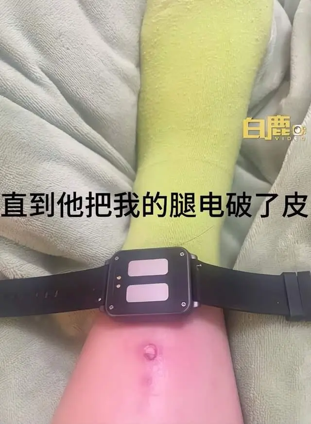 中國女大生為了早起使用電擊手錶並設置最高 480V 電壓，結果睡死導致手腕燒傷破皮 - 電腦王阿達