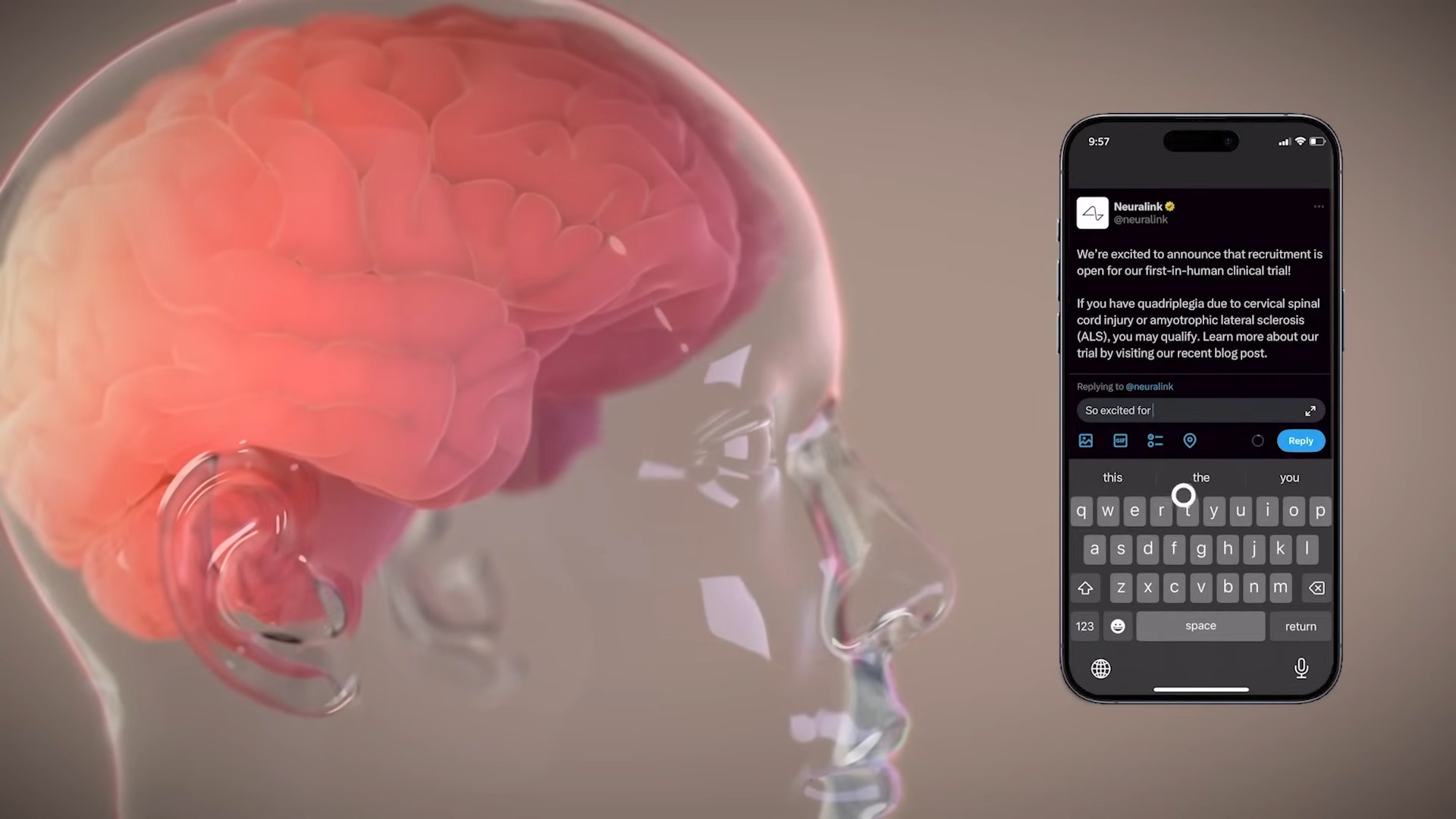 馬斯克宣布 Neuralink 完成首位晶片植入人腦的人體實驗 - 電腦王阿達